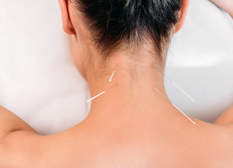 Acupuncture for Mental Health: What are the Benefits?