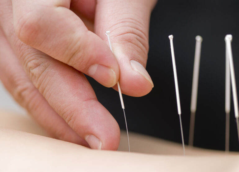 Addressing Some of the Myths of Acupuncture Treatment