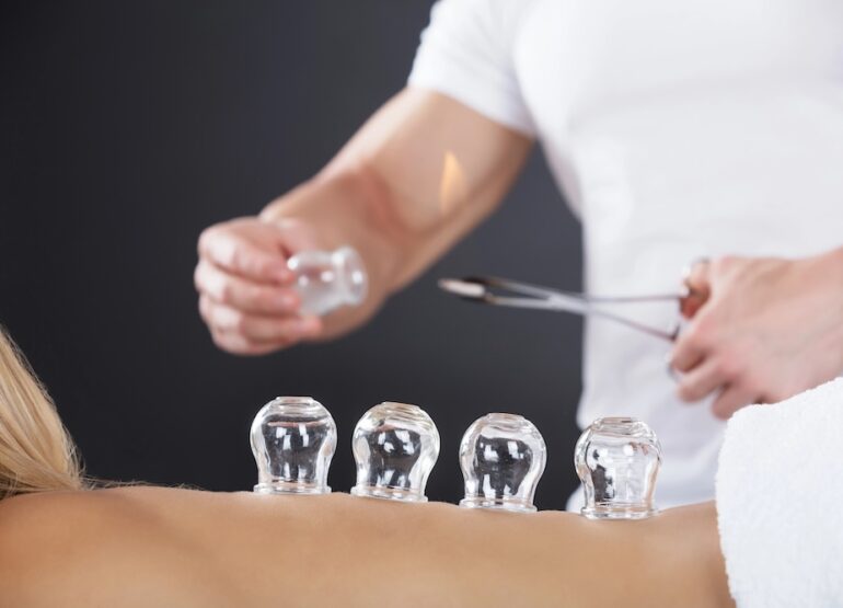 The Healing Power of Cupping and Massage in Integrative Medicine
