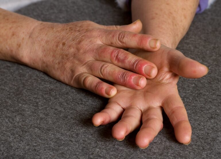 Integrative Approaches to Autoimmune Conditions